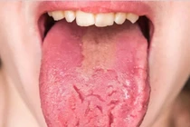 Dấu hiệu khác lạ ở lưỡi cảnh báo những bệnh nguy hiểm