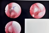 Bé gái 13 tháng tuổi bị vắt chui vào hốc mũi 