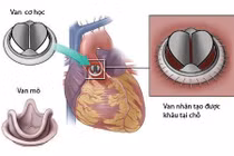 Dùng tiêu sợi huyết cứu bệnh nhân kẹt van tim nhân tạo