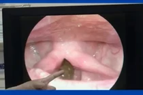 Phát hiện đỉa dài 6 cm sống trong cổ họng người đàn ông