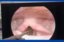 Phát hiện đỉa dài 6 cm sống trong cổ họng người đàn ông