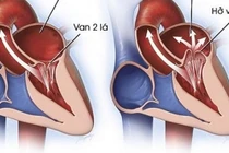 Hở van tim có nguy hiểm không, khi nào cần phẫu thuật?