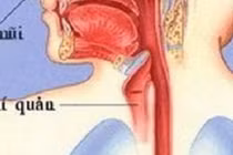 Dấu hiệu cảnh báo khối u vùng cổ ác tính