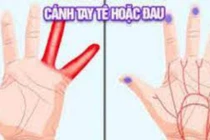Dấu hiệu bàn tay cảnh báo căn bệnh nguy hiểm đừng dại bỏ qua