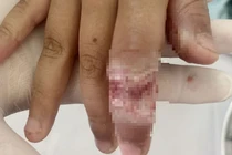 Bé trai bị bỏng tay nặng khi rút điện thoại đang sạc