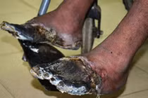 Người sống bị “chết khô” 2 chân vì hút thuốc lá