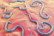 Gắp hơn 100 con giun đũa trong ruột bé trai 2 tuổi