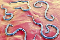 Gắp hơn 100 con giun đũa trong ruột bé trai 2 tuổi