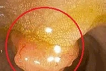 Người phụ nữ 34 tuổi cùng lúc mắc hai bệnh ung thư