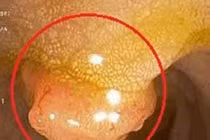 Người phụ nữ 34 tuổi cùng lúc mắc hai bệnh ung thư