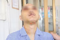 Đặt nội khí quản dưới cằm cứu bệnh nhân đa chấn thương hàm mặt