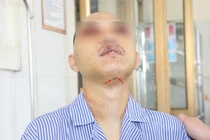 Đặt nội khí quản dưới cằm cứu bệnh nhân đa chấn thương hàm mặt