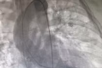 Đang hồi sức tích cực do chấn thương sọ não thì “vỡ tim” 