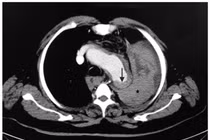 Người đàn ông 50 tuổi tử vong sau cú hắt hơi