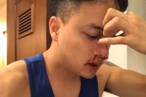 Cao Thái Sơn chảy máu mũi nhập viện khẩn cấp lúc nửa đêm