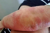 Cách chăm sóc cho trẻ bị viêm da cơ địa