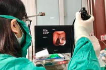 Gắp con vắt dài 5cm trong đường hô hấp của thai phụ 21 tuổi