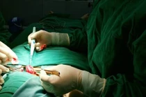 Bổ sung hormon tuyến giáp quá liều nhiều người tai biến