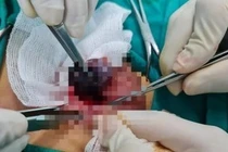 Xoắn tinh hoàn, giờ vàng xử trí tránh biến chứng vô sinh