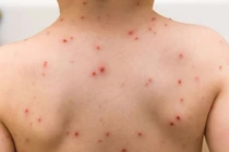 TP HCM: 3 trẻ tử vong liên quan bệnh sởi, phòng tránh thế nào?