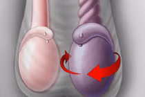 Thanh niên 16 tuổi bị xoắn tinh hoàn hoại tử