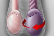 Thanh niên 16 tuổi bị xoắn tinh hoàn hoại tử