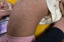 Bé gái 4 tuổi ở Hà Nội tử vong do sởi