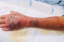 Người đàn ông bị hoại tử tay do cháu bé 3 tuổi cắn