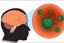 Bé 6 tháng tuổi mắc não mô cầu, dấu hiệu cảnh báo bệnh