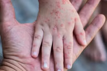 Ai có nguy cơ cao mắc bệnh sởi, phòng tránh thế nào?