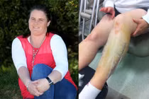 Chân “nổ tung”, tê liệt sau khi đi bộ 10 km