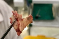 Gắp thành công mảnh xương nằm trong mũi người bệnh 