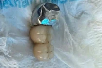 Nuốt cầu răng giả khi ăn phở, dị vật thế nào nguy hiểm?