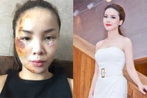 Ca sĩ Yến Trang tái xuất xinh đẹp sau tai nạn