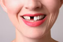 Nằm mơ thấy mình bị gãy răng, điềm lành hay dữ?