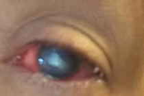 Gái xinh bị ăn mất giác mạc vì kính áp tròng