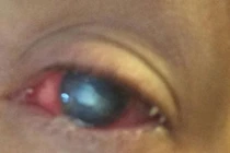 Gái xinh bị ăn mất giác mạc vì kính áp tròng