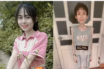 Nhiều năm không ăn cơm giảm cân, cô gái chỉ còn da bọc xương