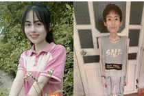 Nhiều năm không ăn cơm giảm cân, cô gái chỉ còn da bọc xương