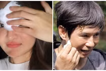 Thùy Anh khâu 4 mũi trên trán, loạt sao gặp tai nạn phim trường