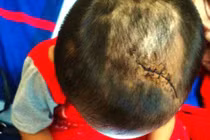 Kinh hãi vết thương trên người bé 3 tuổi nghi bị cha dượng bạo hành