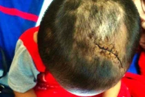 Kinh hãi vết thương trên người bé 3 tuổi nghi bị cha dượng bạo hành