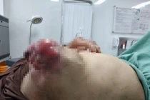 Ngực sưng phồng, chảy mủ lở loét vì đắp lá chữa ung thư
