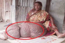 Chân khổng lồ gần 60 kg khiến người phụ nữ liệt suốt 18 năm