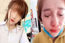 Cô gái bị bạn trai cũ đánh dập mũi vì không nghe lời?
