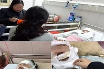 9X bị bỏng do nổ bóng bay không mù mắt nhờ đeo kính