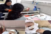 9X bị bỏng do nổ bóng bay không mù mắt nhờ đeo kính