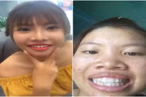 Phượng "Thị Nở" khoe răng cũ lởm khởm để PR răng mới 