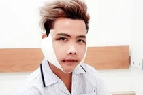 "Giật mình" trước nhan sắc của Tùng Sơn sau phẫu thuật thẩm mỹ