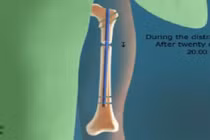 Cận cảnh quy trình phẫu thuật kéo dài chân